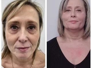 Clínica Carlos Gómez - Rejuvenecimiento