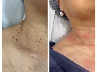 Clínica Carlos Gómez - Acrocordones