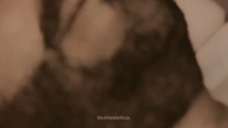 ✨ Aumento de labios masculino con ácido hialurónico ✨