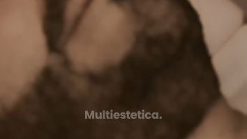 ✨ Aumento de labios masculino con ácido hialurónico ✨