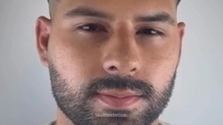 Resultado a las 7 días de su cirugía de rinoplastia