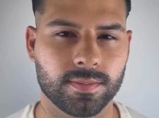 Resultado a las 7 días de su cirugía de rinoplastia