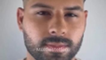 Resultado a las 7 días de su cirugía de rinoplastia