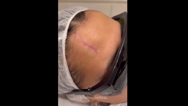 Corrección cicatrices - Clinica Doctor Morano