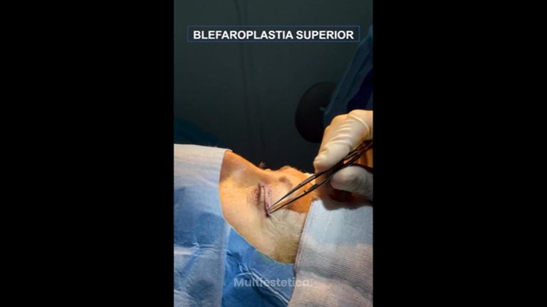 Blefaroplastia - Dr. Jiménez Ortiz
