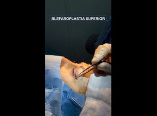 Blefaroplastia - Dr. Jiménez Ortiz
