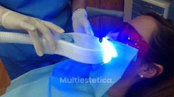 Blanqueamiento dental - Clínica Thous