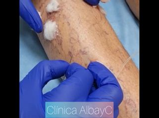Tratamiento varices - ClinicaAlbayC