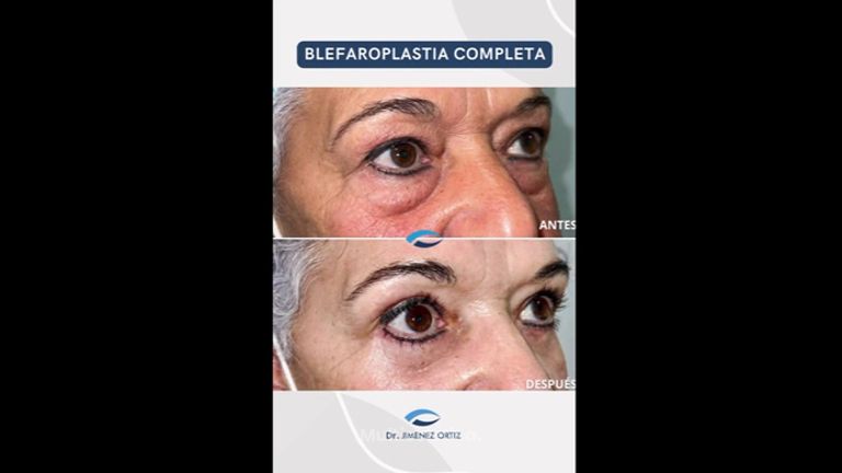 Blefaroplastia - Dr. Jiménez Ortiz