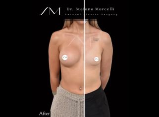 Aumento de pecho - Dr. Stefano Marcelli