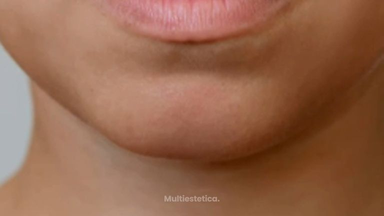 RELLENO DE LABIOS- NATURALIDAD COMO OBJETIVO