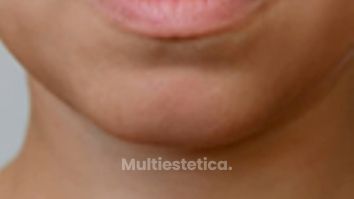 RELLENO DE LABIOS- NATURALIDAD COMO OBJETIVO