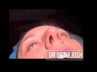 Dr Francisco Ortiz Bish Rinoplastia