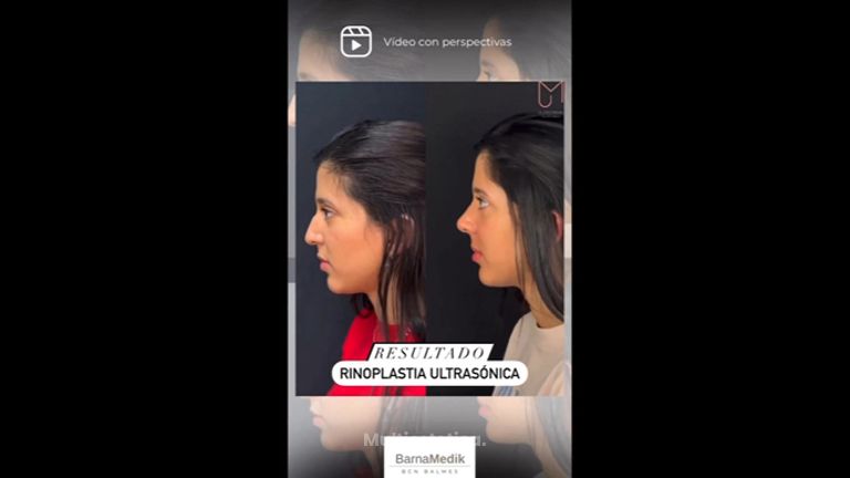 Rinoplastia - Clínica BarnaMedik