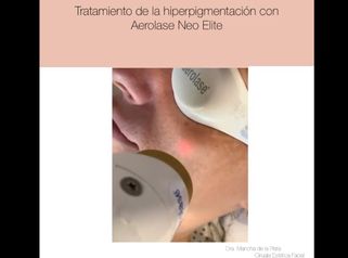 Tratamiento de la hiperpigmentación (melasma) con Aerolase