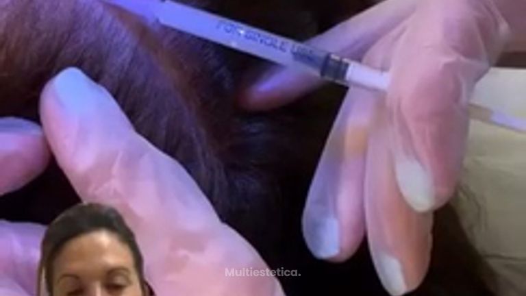 ✨ Mesoterapia Capilar vs Tratamiento vía oral ✨#clinicavillafañe #medicinaestetica