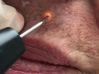 Clínica Dr. Omar López - Verrugas
