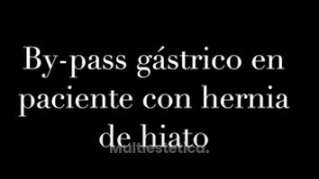 Bypass gástrico con hernia de hiato - Dr. David Martinez Cecilia