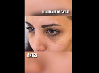 Eliminación de ojeras - CLINICAS DH Clínicas Médico - Estéticas Zaragoza
