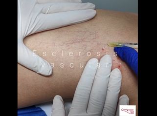 Tratamiento de varices - Clínica De Medicina Estética Córdoba