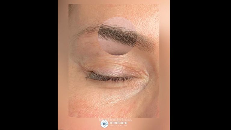 Microblading - Medcare Health & Beauty