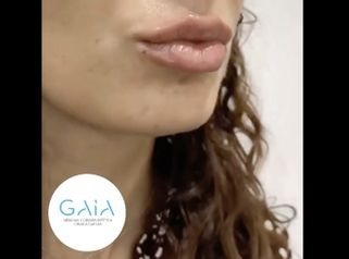 Aumento de labios - Clínica Gaia