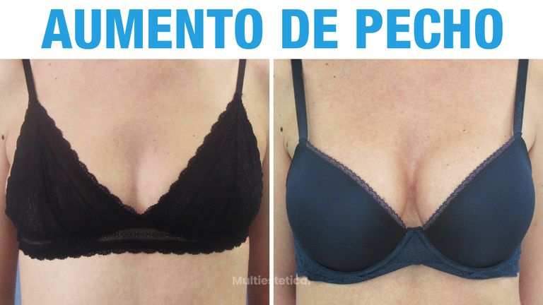 Testimonio de Aumento de Pecho 