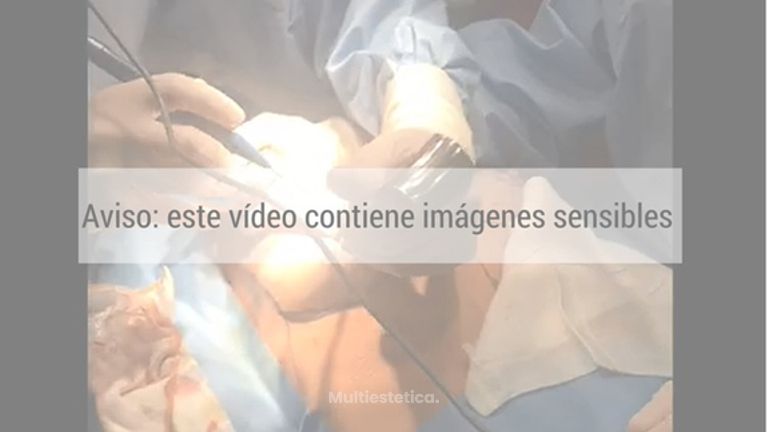 Mamoplastia de aumento
