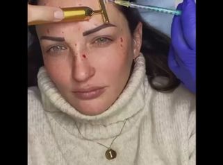 Toxina botulínica - Clínica Rossi Lemarie