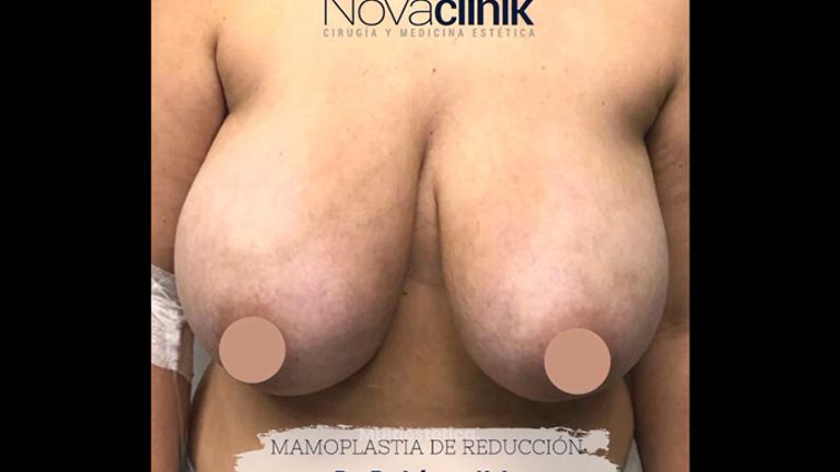 Reducción de senos - NovaClínik