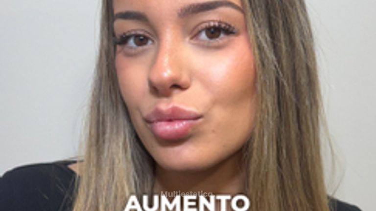 Aumento de labios - Clínica Opción Médica
