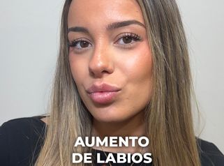 Aumento de labios - Clínica Opción Médica