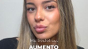 Aumento de labios - Clínica Opción Médica