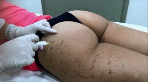cómo se realiza la mesoterapia