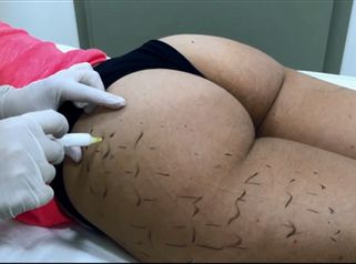 Disolver de manera rápida la grasa acumulada