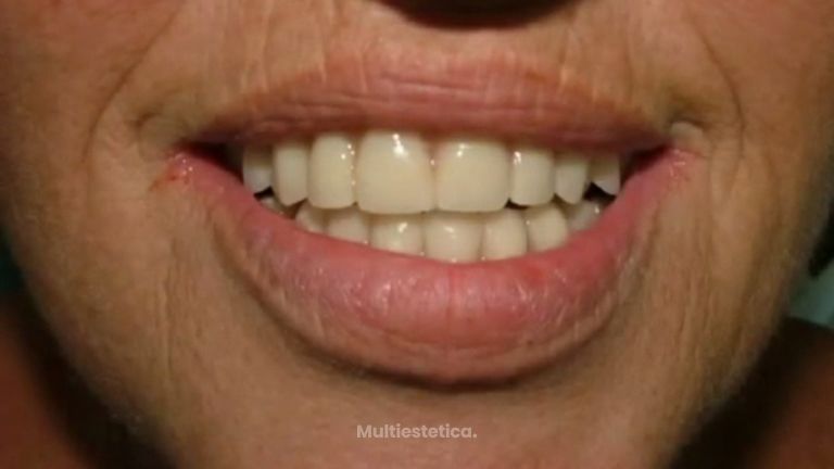 Acaba con tus problemas dentales gracias a los implantes