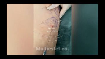 Lipoláser para celulitis - Her Láser