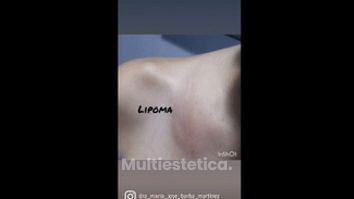 Lipoma - Doctora Barba Martínez