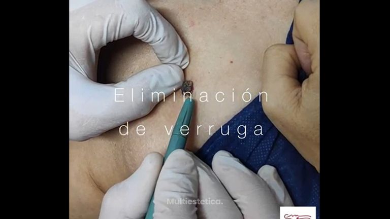 Verrugas - Clínica De Medicina Estética Córdoba