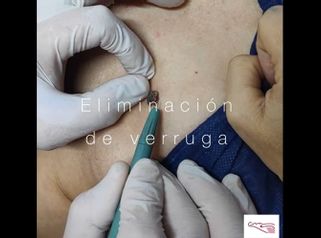 Verrugas - Clínica De Medicina Estética Córdoba