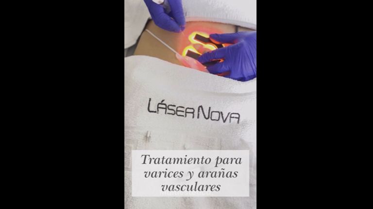 Tratamiento varices - Clínica Lasernova