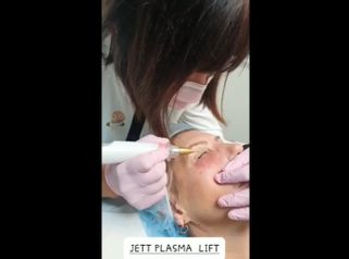 Blefaroplastia sin cirugía - Clinica Renobell