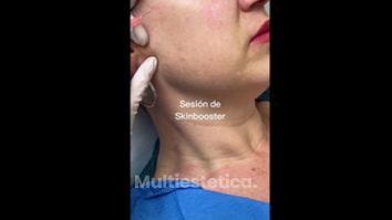 Skinbooster - Clínica Vega