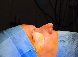 Rinoplastia - Clinica Silvia Roson