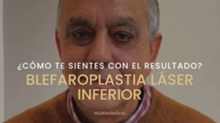 Blefaroplastia Láser Inferior