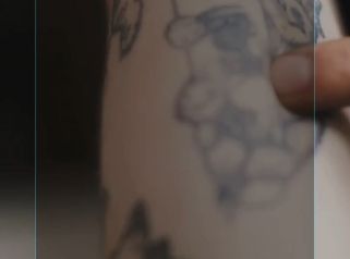 💉 Eliminación Quirúrgica de Tatuajes⌛