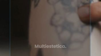 💉 Eliminación Quirúrgica de Tatuajes⌛
