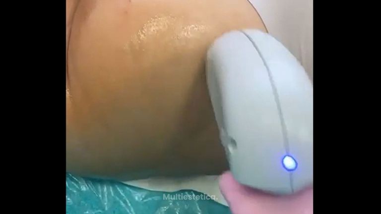 Celulitis - Humildad Ruiz