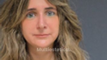 Rinoplastia 14 días despues