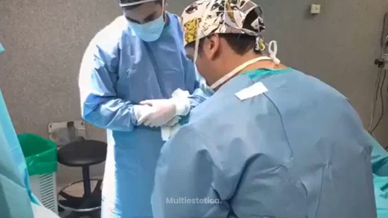 Liposucción 